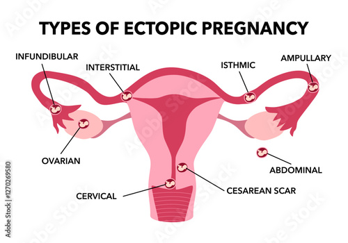 Ectopic Pregnancy. Types of Tubal pregnancy, ovarian, abdominal, cervical pregnancy. medical diagram with female reproductive system and various embryo attachment locations.