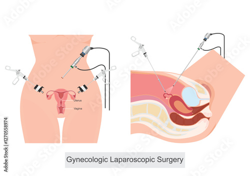 Gynecologic Laparoscopic Surgery is a minimally invasive surgical procedure.