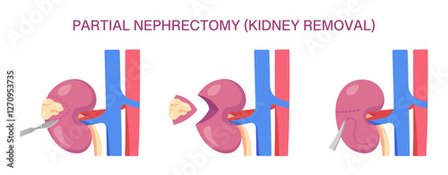 Partial Nephrectomy Surgery. Partial Nephrectomy Kidney Removal. Cross Section. Vector medical illustration of kidney removal procedure with incision, resection, and suturing.