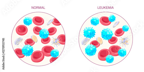 Leukemia Blood Cells Medical Illustrations. Normal And Leukemia Blood Cells. Vector medical illustration comparing normal and leukemia affected blood with abnormal white blood cell count.