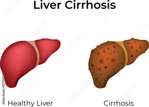 Liver Cirrhosis Healthy vs Diseased Design Vector Illustration