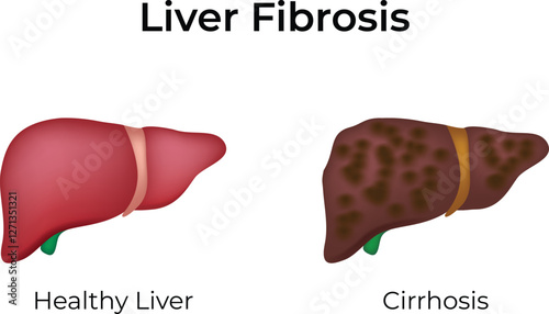 Liver Fibrosis vs Healthy Liver Design Vector Illustration