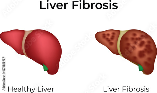 Liver Fibrosis Healthy vs Diseased Liver Design Vector Illustration