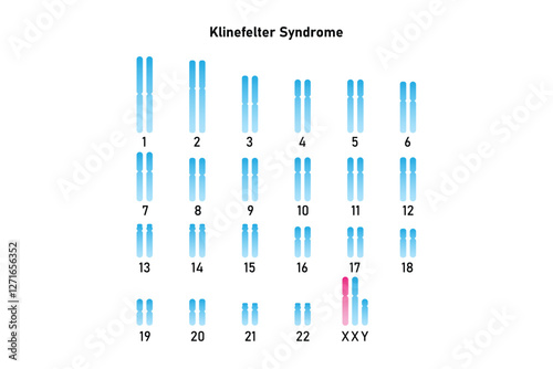 Klinefelter Syndrome Science Design. Vector Illustration.
