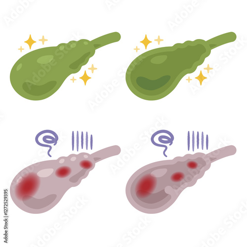 健康でキレイな胆嚢と炎症が起きた不健康な胆嚢のイラスト