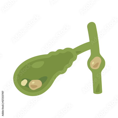 胆石ができた胆嚢のイラスト1
