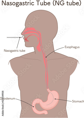 胃ドレナージ、Nasogastric tube