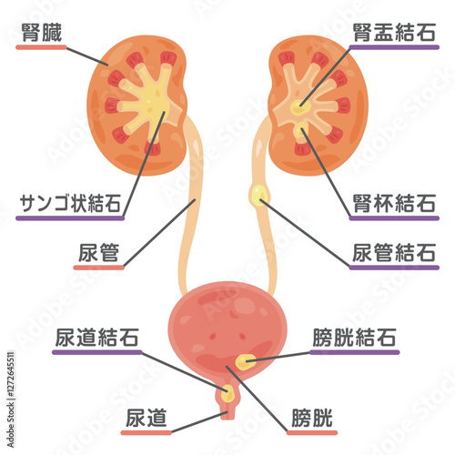 結石ができた腎臓と膀胱のイラスト1