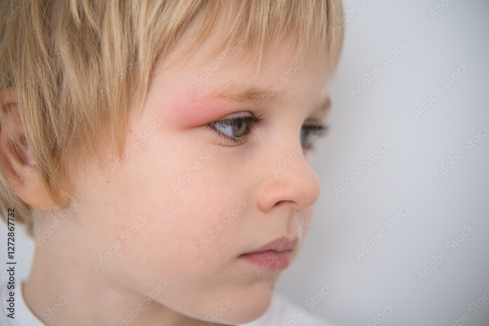 close up little boy with allergic red spot at eye cause by mosquito bite close up little boy with allergic red spot at eye cause by mosquito bite