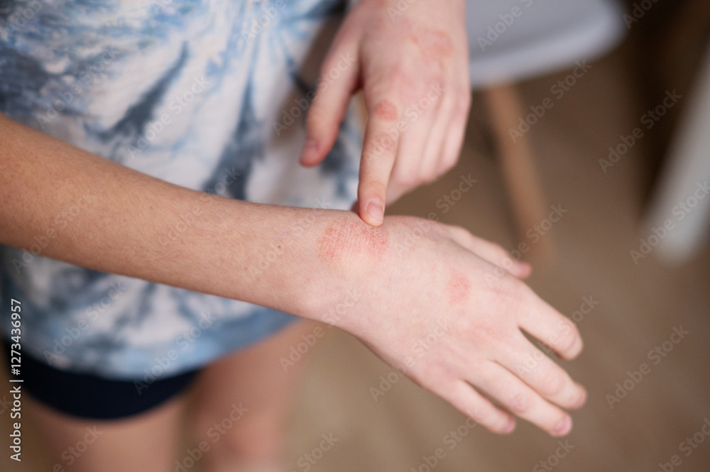 Cold dermatitis on a child's arm. How to treat peeling on your hands during the cold season. Close-up. Cold dermatitis on a child's arm. How to treat peeling on your hands during the cold season. Close-up.