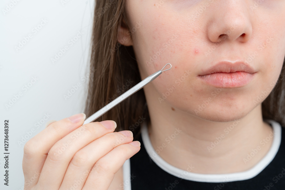 Young woman holding pimple removal tool near face showing pimple on a cheek. Comedones extractor. Inflamed acne and post-acne marks, redness. Hormonal acne treatment, puberty, adult acne, rosacea. Young woman holding pimple removal tool near face showing pimple on a cheek. Comedones extractor. Inflamed acne and post-acne marks, redness. Hormonal acne treatment, puberty, adult acne, rosacea.