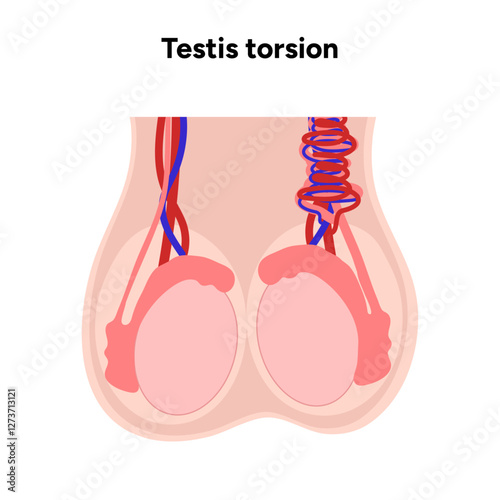 Testis torsion Testicular disease. Man reproductive health system pain testicle pathology problem. Medical diagram 