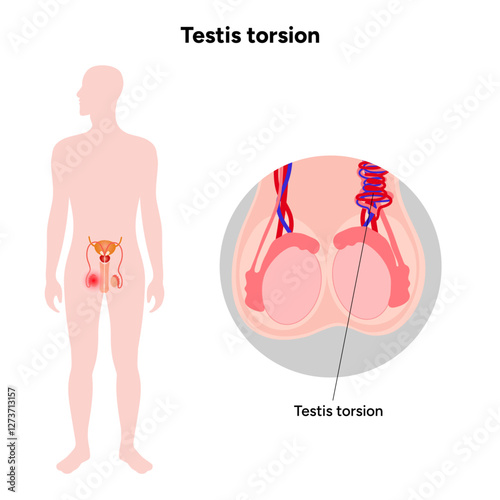 Testis torsion Testicular disease. Man reproductive health system pain testicle pathology problem. Medical diagram 