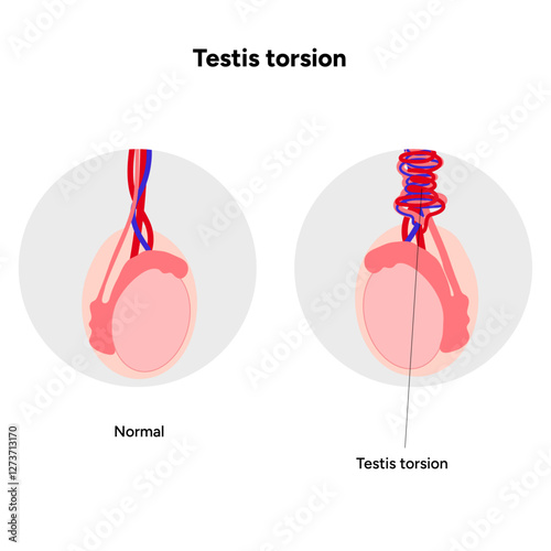 Testis torsion Testicular disease. Man reproductive health system pain testicle pathology problem. Medical diagram 