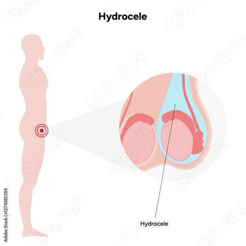 Hydrocele Testicular disease. Man pain testicle pathology problem. Medical diagram 