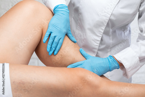 Removal of varicose veins on the legs. Medical inspection and treatment of Telangiectasia. Phlebeurysm.