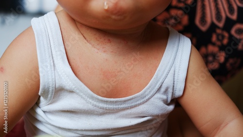 Severe prickly heat on the baby's neck.