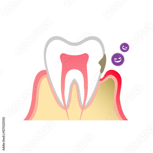 歯周ポケットが汚れ歯周病になっている歯のイラスト