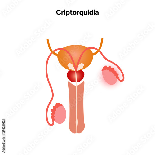 Criptorquidia Testicular disease. Man cryptorchidism pain testicle pathology problem. Medical diagram 