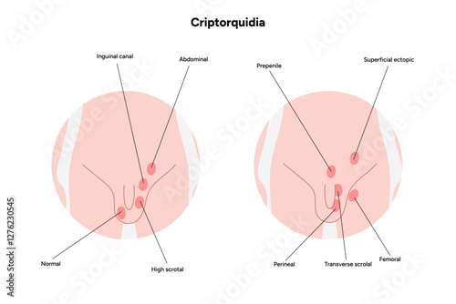 Criptorquidia Testicular disease. Man cryptorchidism pain testicle pathology problem. Medical diagram 