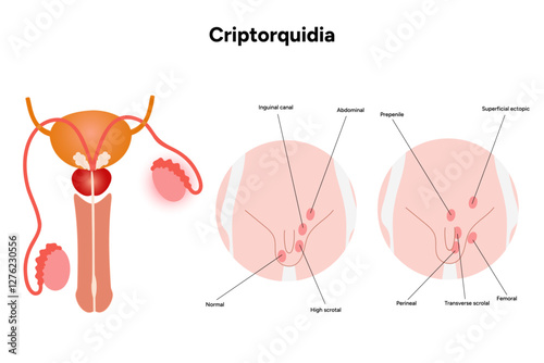 Criptorquidia Testicular disease. Man cryptorchidism pain testicle pathology problem. Medical diagram 