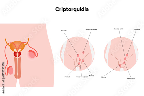 Criptorquidia Testicular disease. Man cryptorchidism pain testicle pathology problem. Medical diagram 