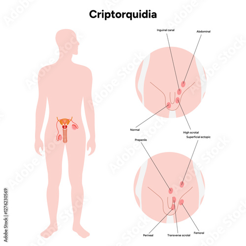 Criptorquidia Testicular disease. Man cryptorchidism pain testicle pathology problem. Medical diagram 