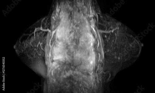 MRI scan of the breasts in an sagittal view with contrast enhancement. photo