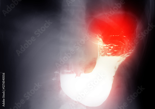 X-ray image of the stomach with barium contrast.
