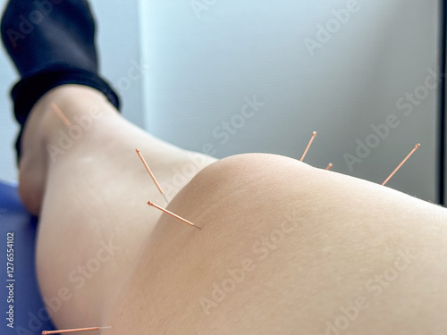 Six acupuncture needles in a swollen knee from top view with black sock on the foot