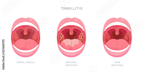 Infographic of sore throat due to bacteria and virus infection. Opened mouth showing of Tonsillitis or tonsil inflammation symptom. Concept of illness, health care, oral disease. Flat vector style.