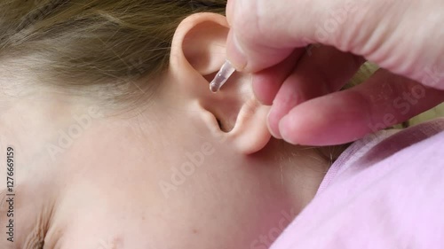 Close-up of a child's ear as an adult applies ear drops with a pipette. Pediatric ear infection treatment, medical care, home health therapy.