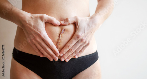 Hands in the shape of a heart on the body of a woman with a surgical stitch on her abdomen sewn with metal staples after a gynecological operation hysterectomy or laparotomy, close-up, copy space
