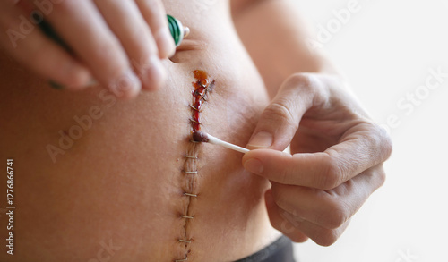 Woman's hands treating with iodine a surgical suture on her belly stitched with metal staples after a gynecological operation hysterectomy or laparotomy, close-up, copy space