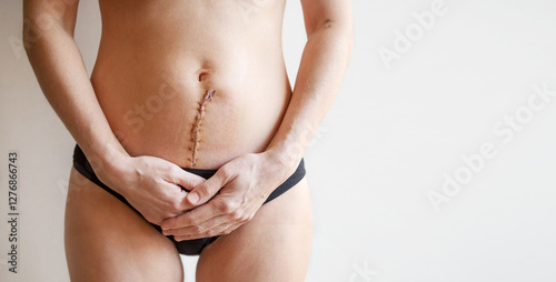 Woman's body with a surgical scar on her abdomen stitched with metal staples after a gynecological operation hysterectomy or laparotomy, or after giving birth by cesarean section, close-up, copy space