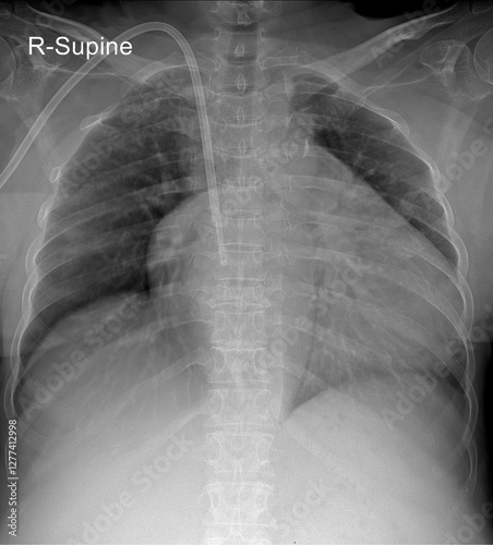 Human Supine Chest X-ray Cardiomegaly photo