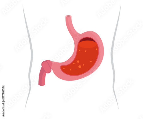 Unhealthy human stomach stock illustration