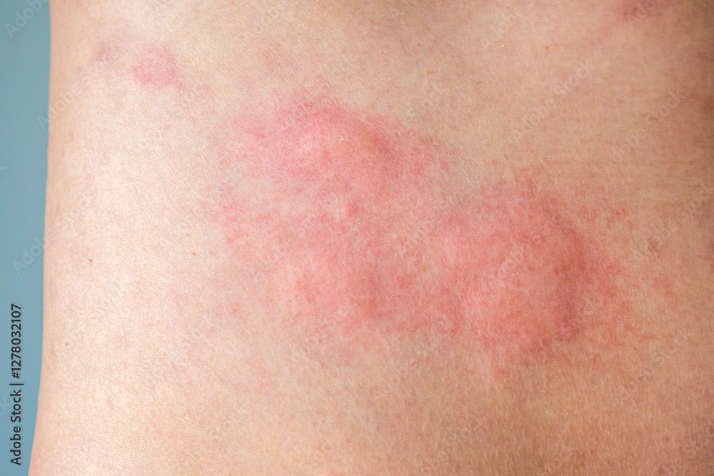 Fototapeta premium Young asian man itching and scratching on his back from allergic itchy dry skin eczema dermatitis insect bites