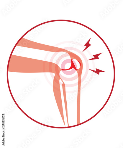 Arthritis in knee joint stock illustration