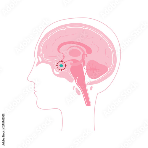 Pituitary adenoma, human head with brain.