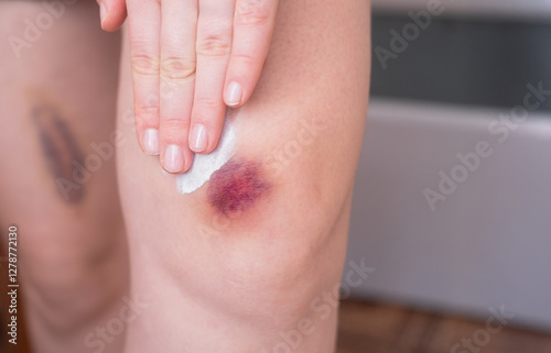 Slika na platnu Woman treats bruises on her body