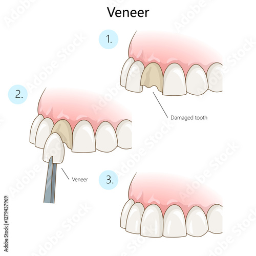 process of applying dental veneer to repair a damaged tooth, showing step-by-step cosmetic dental restoration diagram hand drawn schematic vector illustration. Medical science educational illustration