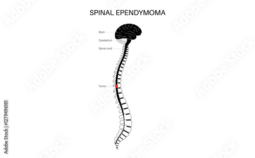 Spinal ependymoma cancer