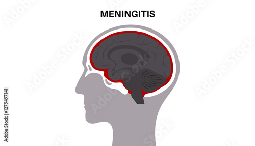 Meningitis medical poster