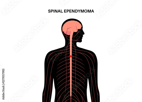 Spinal ependymoma cancer