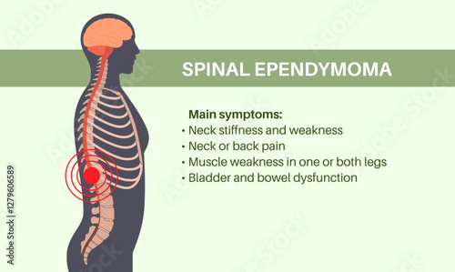 Spinal ependymoma cancer