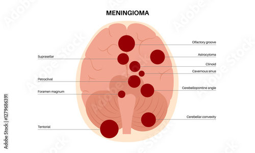 Meningiomas cancer poster