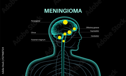 Meningiomas cancer poster