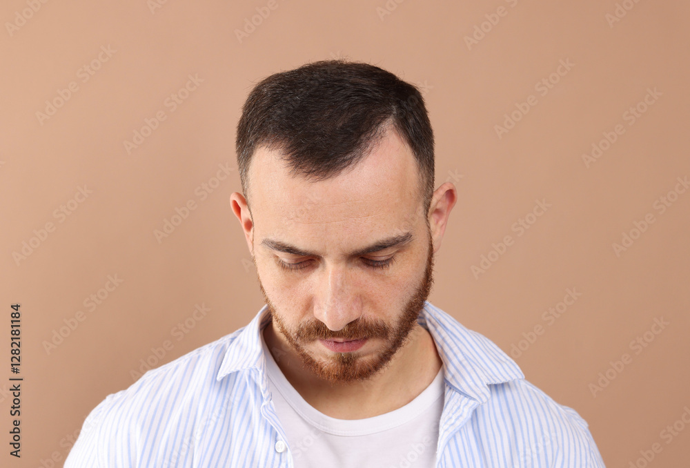 Baldness problem. Man with receding hairline on beige background Baldness problem. Man with receding hairline on beige background