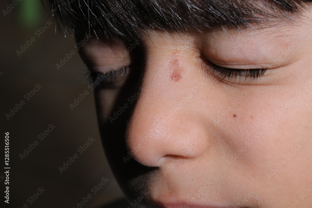 Young boy showing skin birthmark on face Young boy showing skin birthmark on face